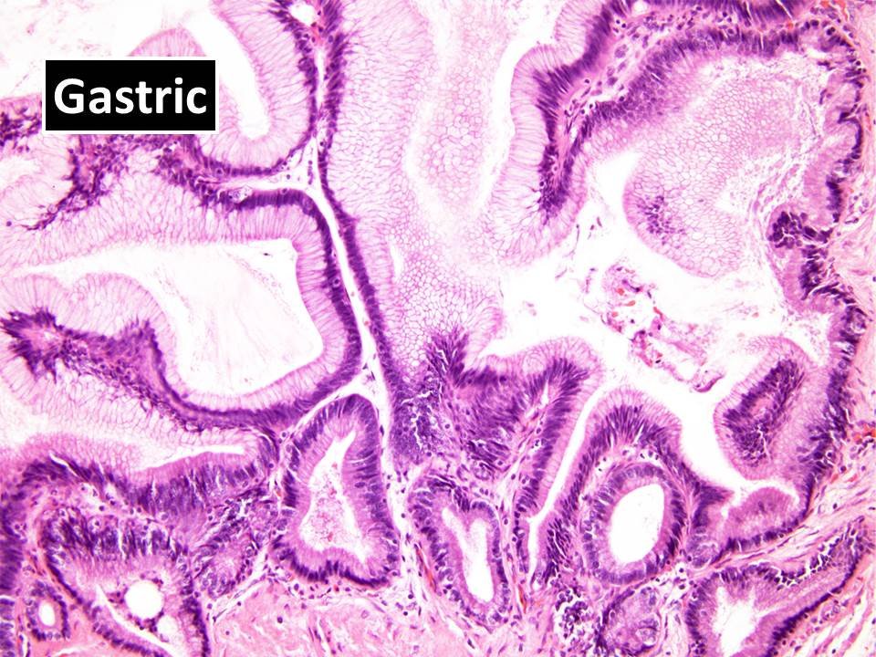 4/n Previously, pancreatic IOPNs (2010 WHO) were classified as a subtype of Intraductal Papillary Mucinous Neoplasms (IPMNs), which is a common  #PancreaticCyst and frequently characterized by genomic alterations involving KRAS and GNAS.  #GIPath  #PancreaticPath  #Pathology