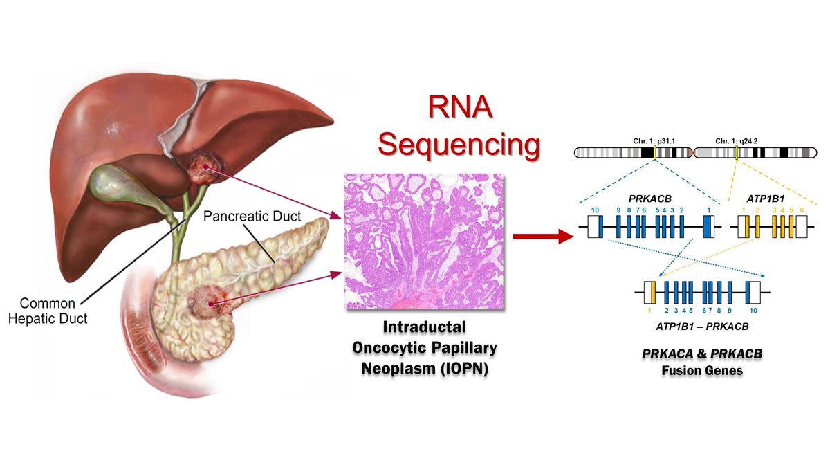 8/n Therefore, we performed RNA-based targeted sequencing and identified recurrent fusions involving the PRKACA and PRKACB gene in both pancreatic (n = 20) and biliary (n = 3) IOPNs.  https://tinyurl.com/y2qehyvq   #PancreaticCyst  #Pathology  #PancreaticCancer