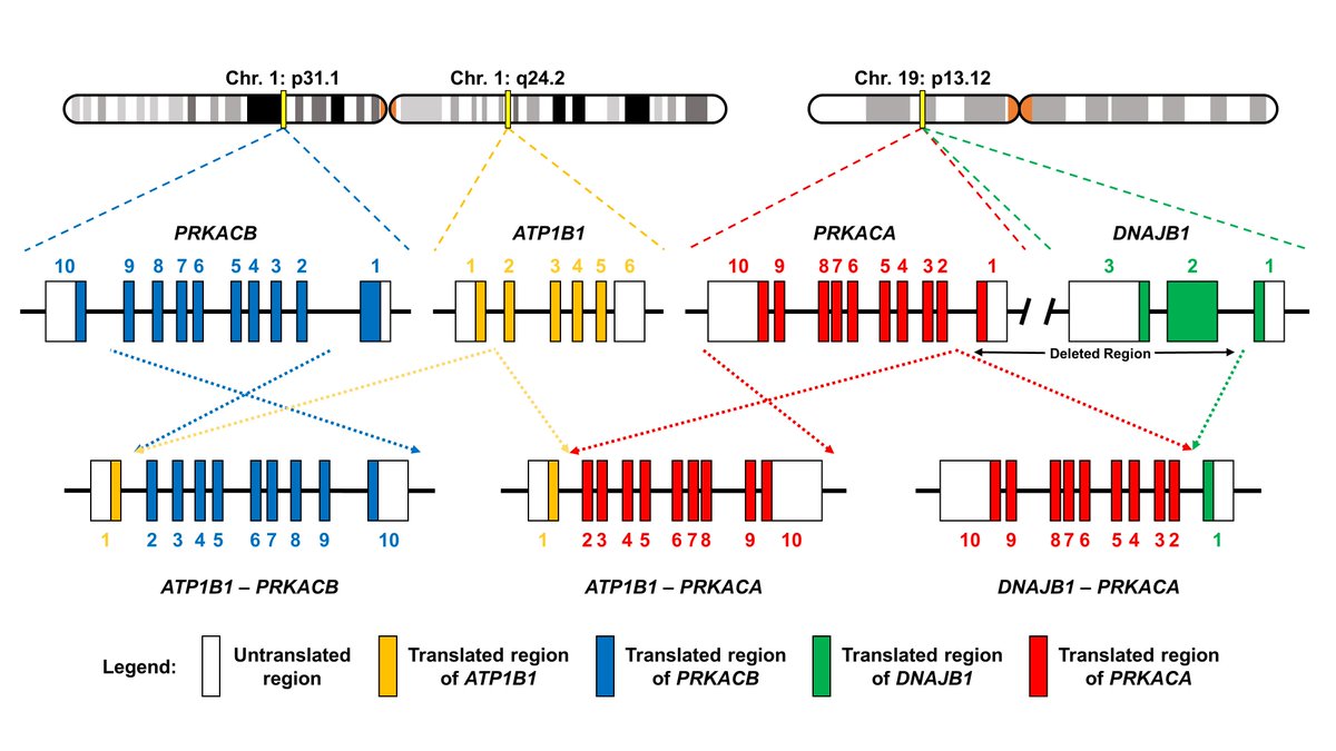 8/n Therefore, we performed RNA-based targeted sequencing and identified recurrent fusions involving the PRKACA and PRKACB gene in both pancreatic (n = 20) and biliary (n = 3) IOPNs.  https://tinyurl.com/y2qehyvq   #PancreaticCyst  #Pathology  #PancreaticCancer