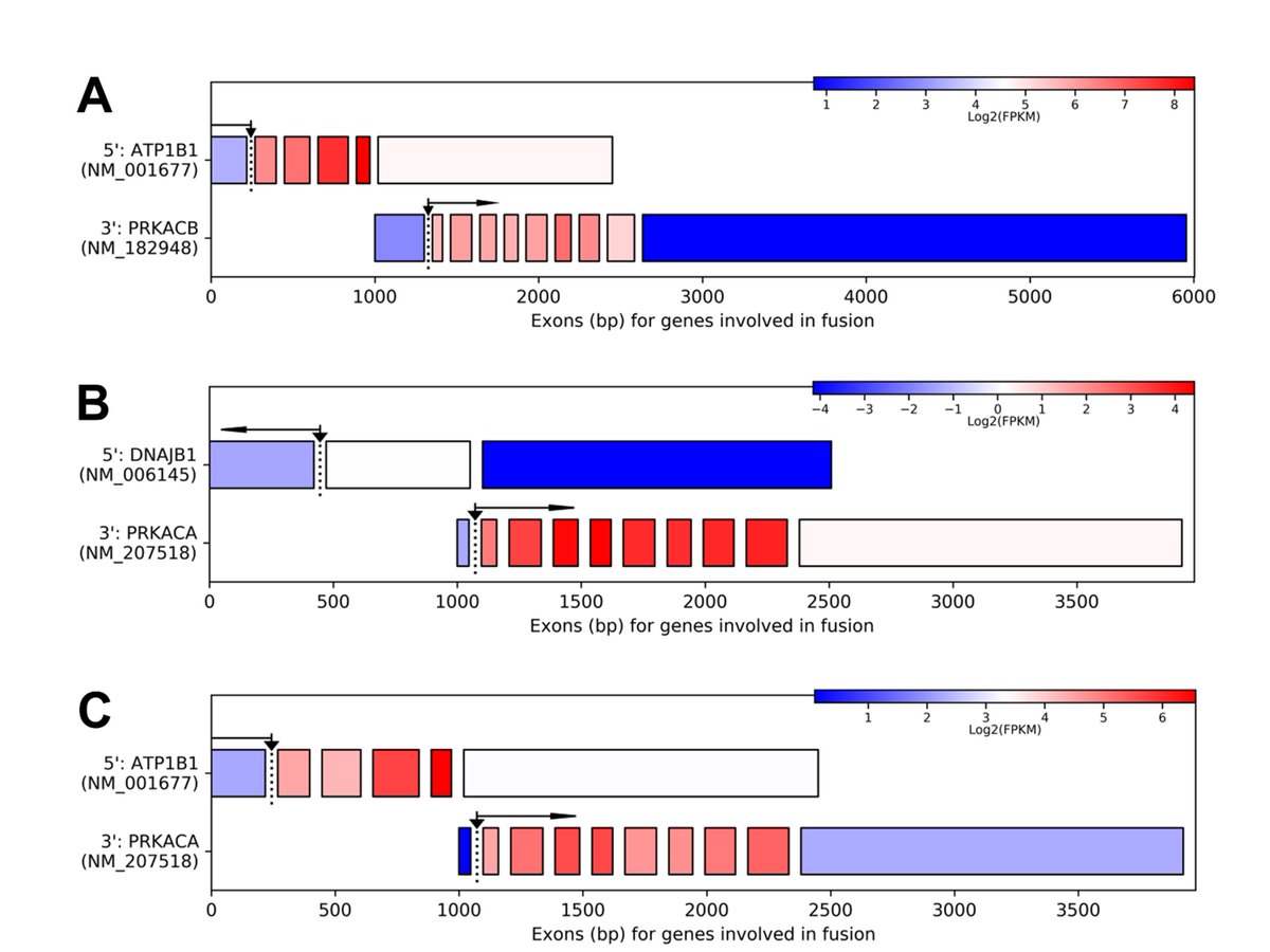 11/n We confirmed the presence of both PRKACA and PRKACB fusion genes by transcriptome sequencing and FISH.  https://tinyurl.com/y2qehyvq   #PancreaticCysts  #PancreaticCancer  #Cholangiocarcinoma