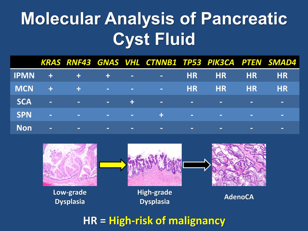 14/n Note, PancreaSeq has been used to help classify and stratify  #PancreaticCysts from >2000 patients. And BiliSeq has been used to evaluate >400 bile duct strictures and identify actionable targets for patients with  #Cholangiocarcinoma  @UPMCnews