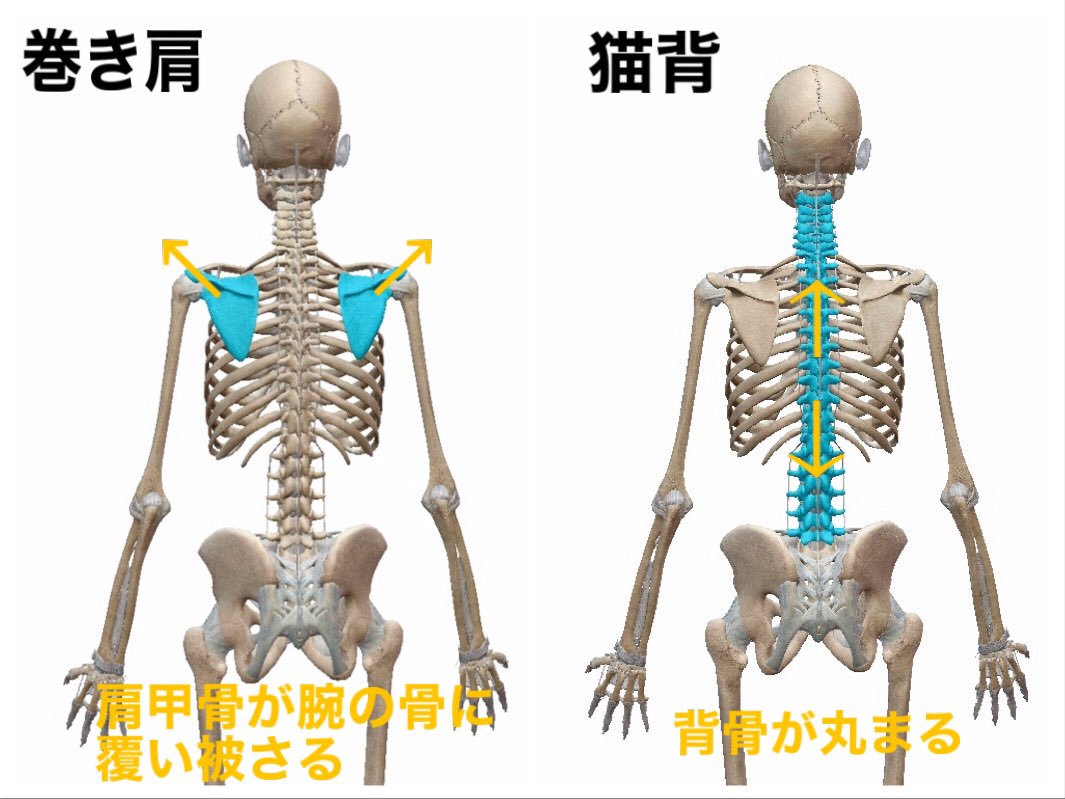 あおば Fitnesslife Coach En Twitter 猫背と巻き肩の違い 猫背 背骨が丸まった状態 巻き肩 肩甲骨が腕の骨に覆い被さった状態 巻き肩は仰向けに寝ると肩が前に出てきるのがよく分かる 肩が床から指2本分以上離れている人は 巻き肩です そんな人は小胸筋を緩め あおば Fitnesslife Coach En Twitter 猫背と巻き肩の違い 猫背 背骨が丸まった状態 巻き肩 肩甲骨が腕の骨に覆い被さった状態 巻き肩は仰向けに寝ると肩が前に出てきるのがよく分かる 肩が床から指2本分以上離れている人は 巻き肩です そんな人は小胸筋を緩め