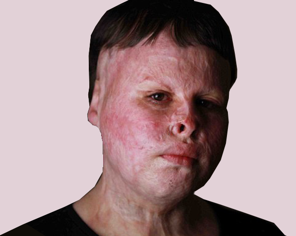 bestsurgeonbpl's tweet photo. The goals of reconstructive burn surgery are to improve both the function and the cosmetic appearance of burn scars. If you are looking for burn reconstruction in Bhopal, visit Dr. Sunil Rathore. #burnreconstruction  #burnsurgery  #plasticsurgery  #cosmeticsurgery #Bansalhospital https://t.co/dKn9vpkS5r
