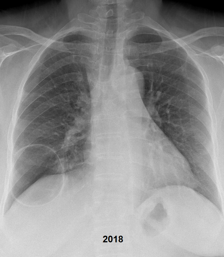 NshRadiology's tweet photo. Long-standing Thin-walled cavitary lesion in RLL presented with severe #hemoptysis due to erosion of a nearby #pulmonary vessel, possibly due to an overlying infection. Treated by #MicrovascularPlug #MVP #IRad #Intervention #Makkah #Radiology https://t.co/ct9xcoaMq0