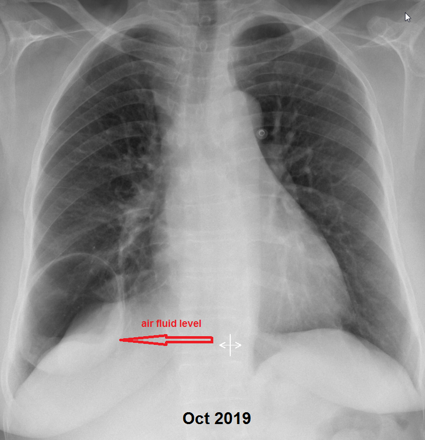 NshRadiology's tweet photo. Long-standing Thin-walled cavitary lesion in RLL presented with severe #hemoptysis due to erosion of a nearby #pulmonary vessel, possibly due to an overlying infection. Treated by #MicrovascularPlug #MVP #IRad #Intervention #Makkah #Radiology https://t.co/ct9xcoaMq0
