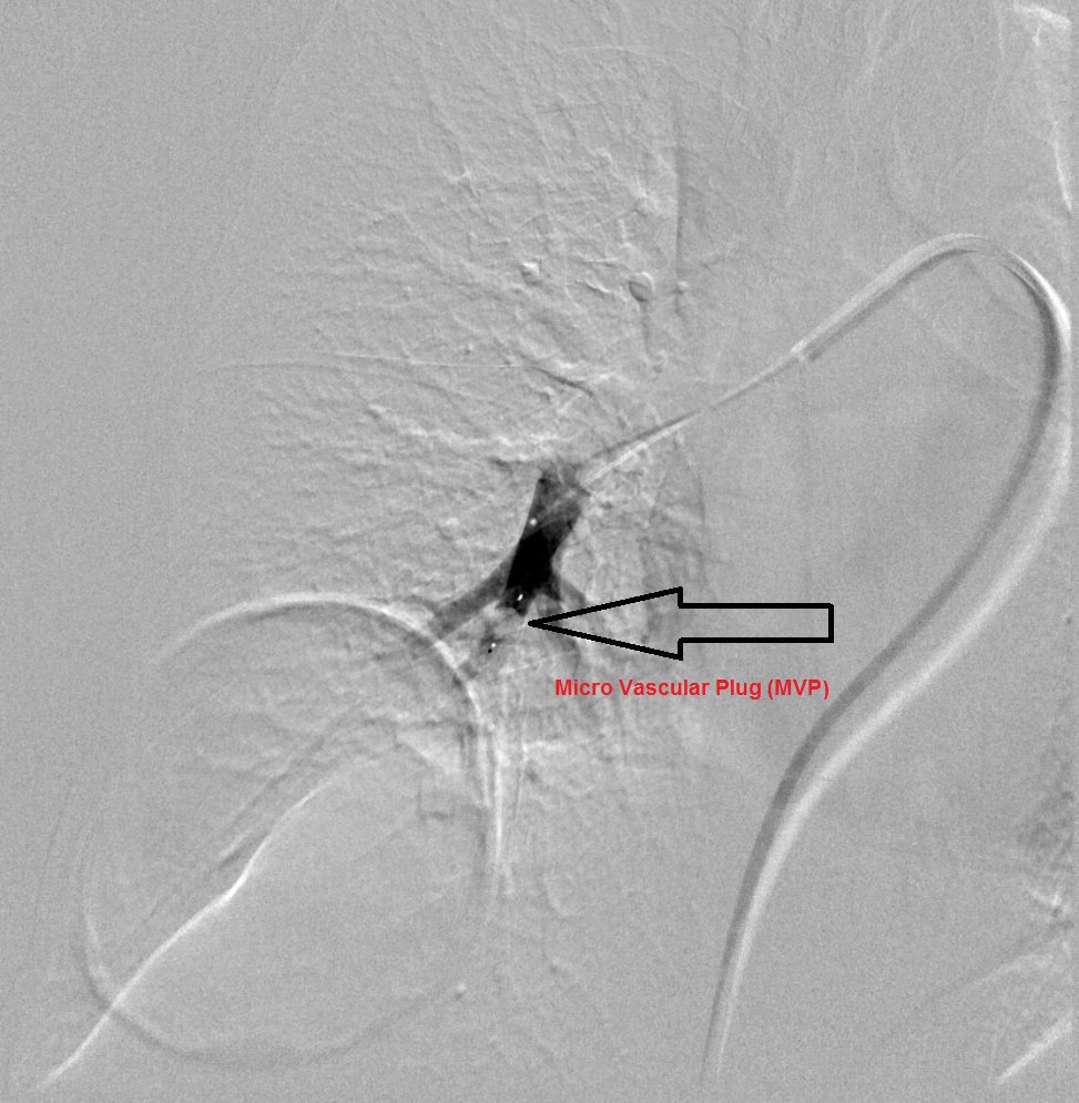 NshRadiology's tweet photo. Long-standing Thin-walled cavitary lesion in RLL presented with severe #hemoptysis due to erosion of a nearby #pulmonary vessel, possibly due to an overlying infection. Treated by #MicrovascularPlug #MVP #IRad #Intervention #Makkah #Radiology https://t.co/ct9xcoaMq0