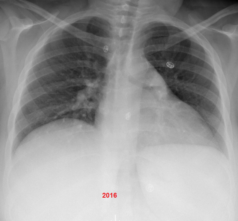 NshRadiology's tweet photo. CRF patient who developed new lung nodules in recent CXR Presented by severe #Hemoptysis. CTA demonstrates a small #Pseudoaneurysm in LLL within a new nodule. Possible #Rassmusen #Aneurysm. Treated using #VascularPlug type IV in a LLL #pulmonary artery branch #IRad #Makkah https://t.co/GBQFcWyUd6