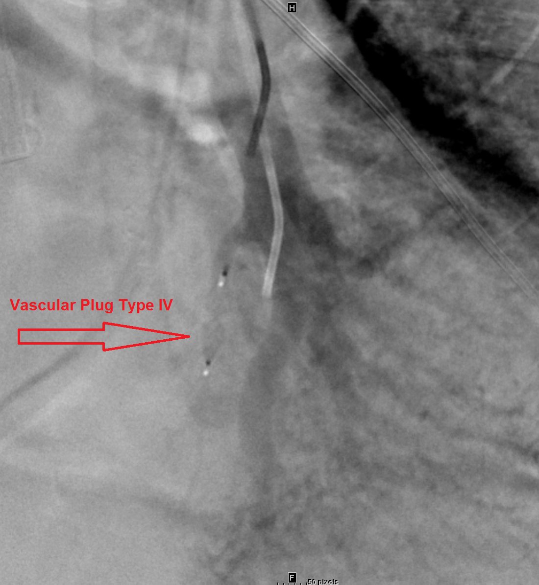 NshRadiology's tweet photo. CRF patient who developed new lung nodules in recent CXR Presented by severe #Hemoptysis. CTA demonstrates a small #Pseudoaneurysm in LLL within a new nodule. Possible #Rassmusen #Aneurysm. Treated using #VascularPlug type IV in a LLL #pulmonary artery branch #IRad #Makkah https://t.co/GBQFcWyUd6