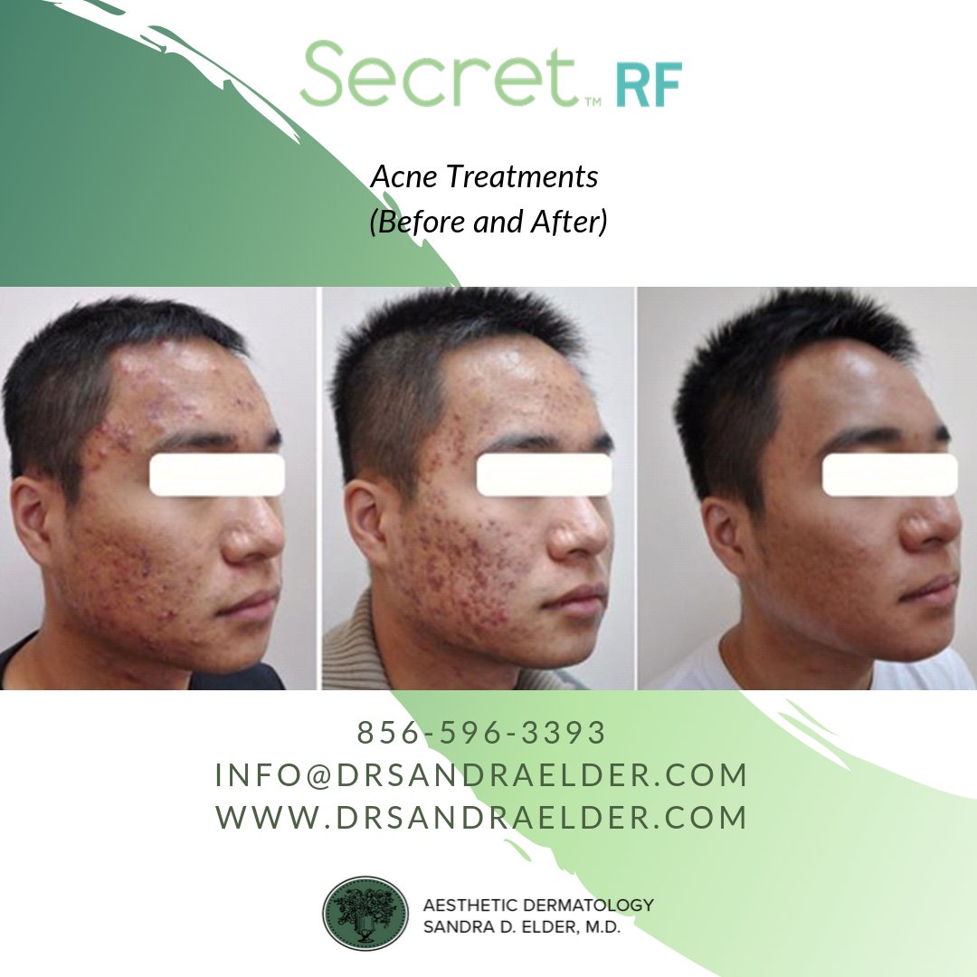 AestheticDerma's tweet photo. What's our #secret? We'll give you a hint! It's a new micro-needling treatment that improves signs of aging skin, fine lines, wrinkles and scars with little to no downtime. Come see what #SecretRF is all about!

Book an appointment today!
☎️(856) 596-3393 https://t.co/dWtd97RWDV