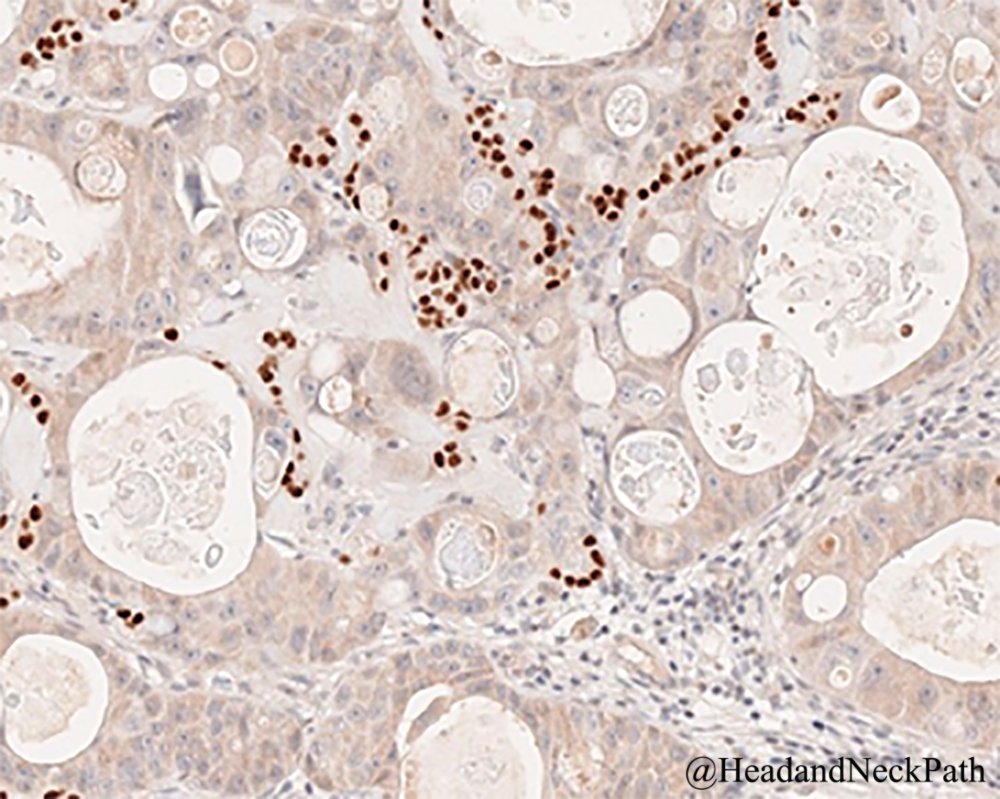 Colon Cancer Metastasis Within a NIFTP: A Case Report and Review of the Literature
rdcu.be/bU5po
#HeadNeckPathol #HNPJ #HeadandNeckPath #Pathology #ENTPath #PathologyTweet