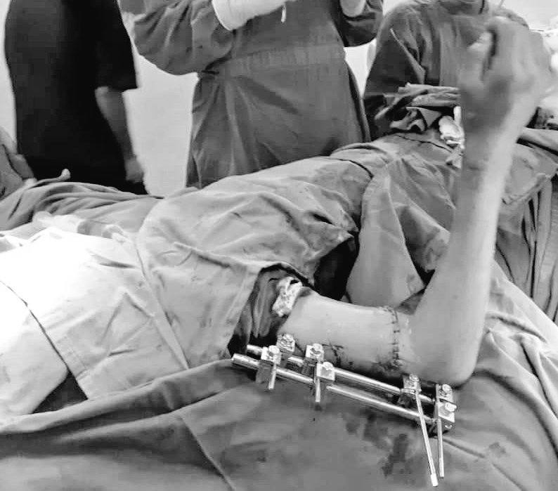 WRadioEc's tweet photo. #ATENCIÓN| En el hospital Vicente Corral el médico Juan Pablo Cáceres y su equipo hicieron el reimplante de un brazo derecho amputado, de un paciente procedente de #Gualaceo. Es un logro sin precedentes en la medicina de #Cuenca

Fuente: #ChristianSánchez https://t.co/3kRd8aJn9I
