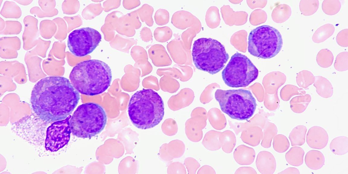 RosaQSP's tweet image. Computer models show promise for personalizing chemotherapy: buff.ly/2M9vHFe

#chemotherapy #stanford #computermodels #Cancer #personalizedmedicine