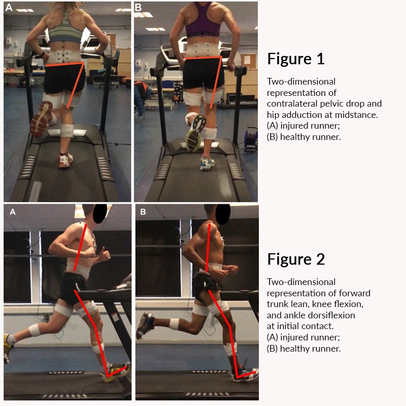 DrAshvinKDewan's tweet photo. Study by Christopher Bramah, et al demonstrating certain running styles can predispose one to injury. A drop in the pelvis (fig 2), or an increased forward lean (fig 1) lead to 80% increase in injuries. @chrisbramah @DrNiamhGill @leehphysio Read more: https://t.co/KYZfTvWfM6 https://t.co/DbRAdmubsz