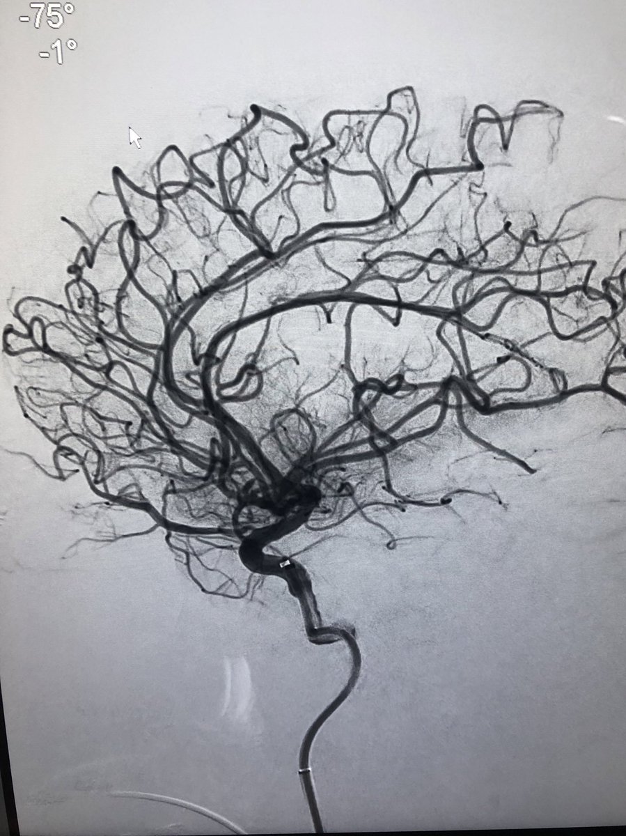 RLHINR's tweet photo. Celebrating our one year anniversary of a 7 day mechanical thrombectomy service @RoyalLondonHosp @NHSBartsHealth #leavenoELVObehind #onwardsandupwards #spectrumstroke #WorldStrokeDay https://t.co/i2cOqDyXwc