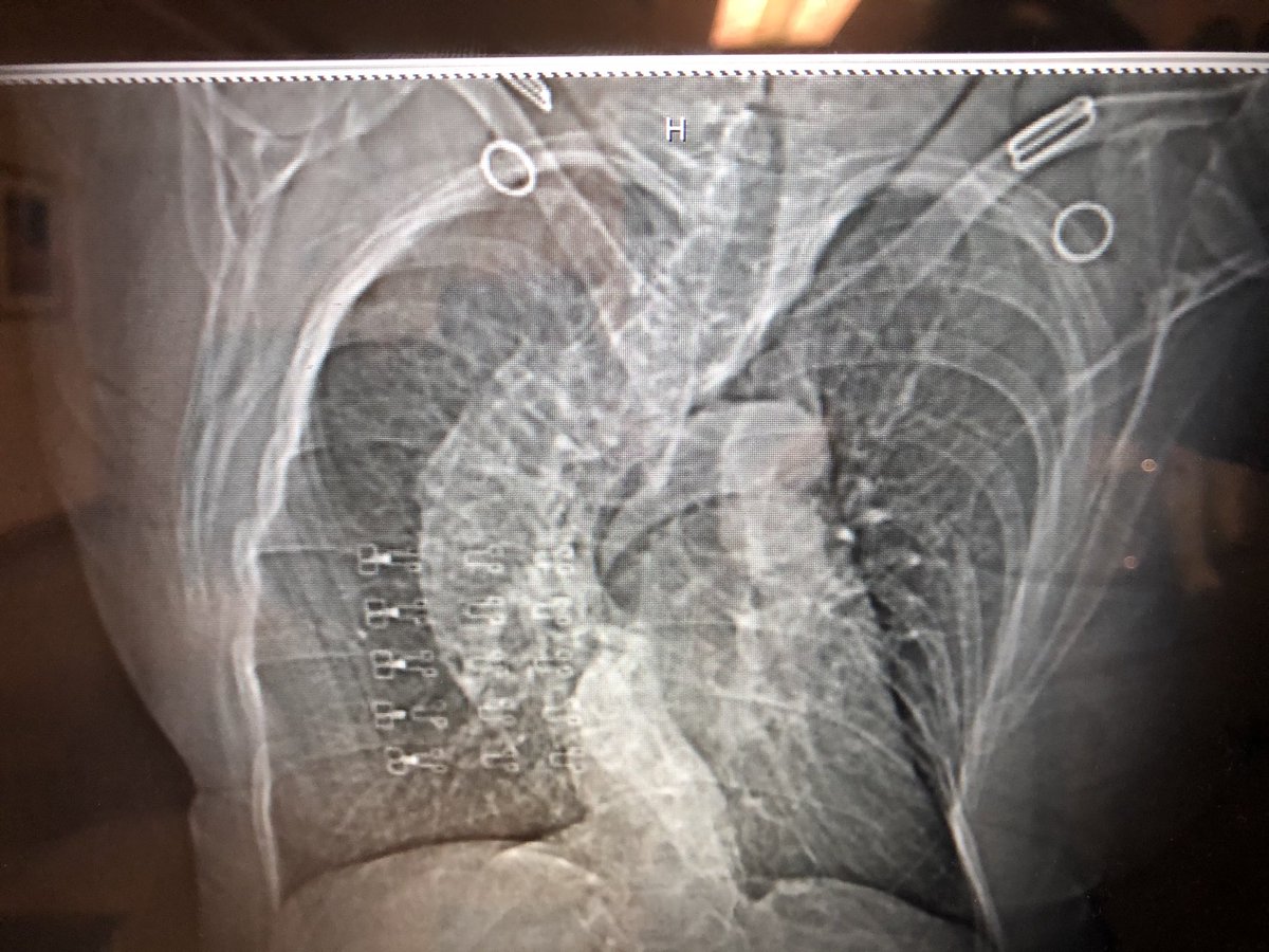 Your best friends when you see this anatomy, ICE and 3 D mapping for PVI with  cryo.