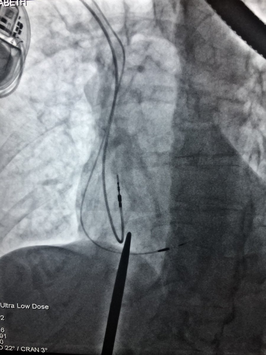 VivekMutha3's tweet photo. Right sided his implant. Any tips ? 
Usual c315 is harder to manipulate 
#dontdisthehis #eppeeps 
@gopi_gdanda1 @UwaisMohamed8 https://t.co/Mw2zpLSQPr