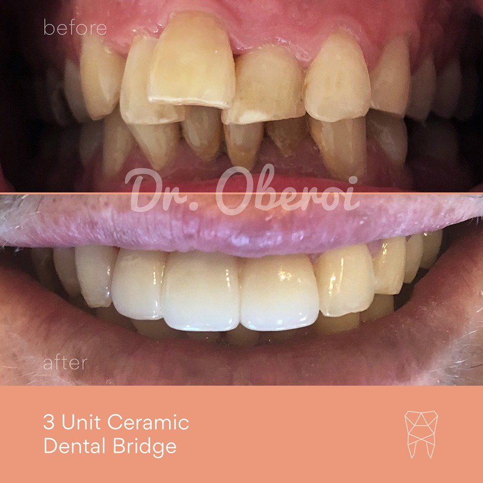 paramountsyd's tweet photo. A ceramic bridge is a great cosmetic solution for #teeth restoration. Our patient couldn't be happier with their new bright smile. To enquire about cosmetic solutions for your #smile please get in touch with our friendly team: (02) 9131 8078
#healthisparamount #beforeandafter https://t.co/HnDtQPA5oO