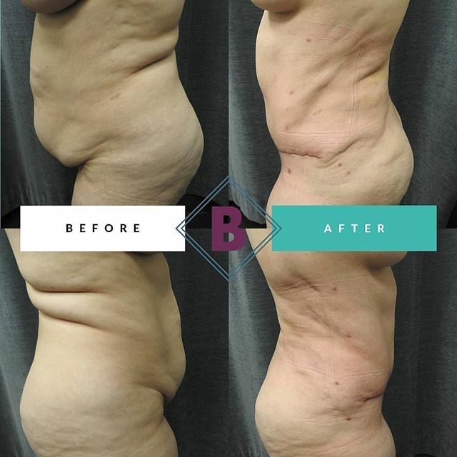 Sometimes no amount of working out or healthy eating can help those stubborn trouble areas especially post-pregnancy. That’s why we’re here to help! ​📞 210.614.0400 to book your appointment and say goodbye to stubborn fat and extra skin with Dr. Cons… ift.tt/335iTXK