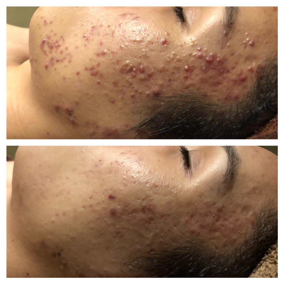 ビューティースタジオ 韓美 ハンミ 新宿本店 韓美の ニキビケア クレーター改善 ぜひ相談くださいね こちらのお客さんはクリニックなどで400万以上使ったお客様を2ヶ月でここまで改善させました