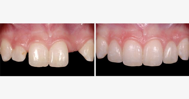 greggkinzerdds's tweet photo. Study Club Module: Managing the Unesthetic Single Tooth Implant: https://t.co/LmA0pQjOTE https://t.co/SjSXSfCJSe