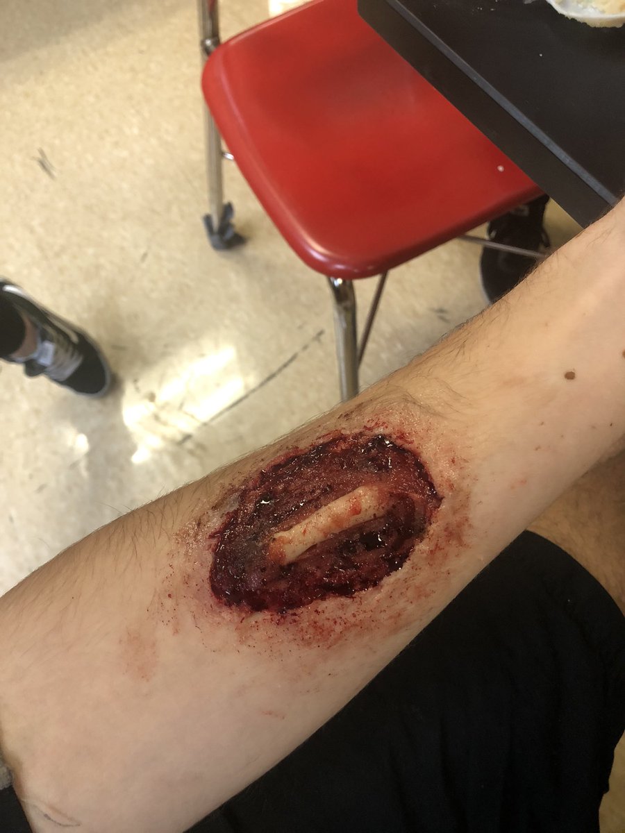 MrsCarroll25's tweet photo. Awesome Halloween activity that lined up perfectly with our study of the integumentary system! #woundlab #describethelocationusinganatomicalterminology #whatlayersoftheskinareaffected https://t.co/2Ql1lYBG29