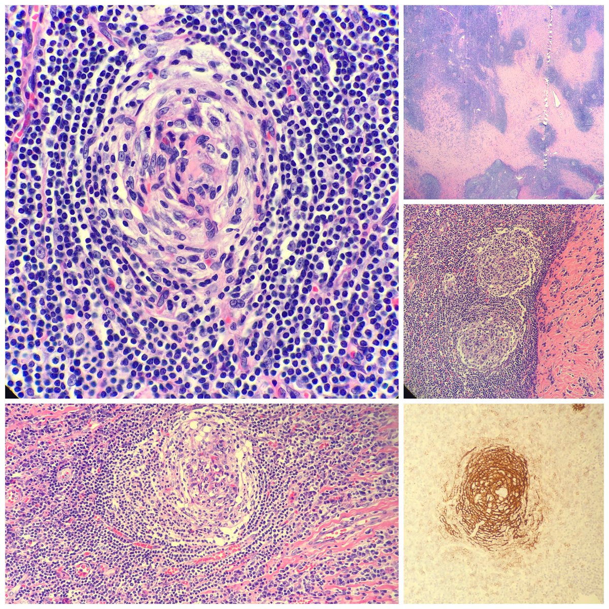 bluehatcomics85's tweet photo. Wanted to show this “treat” of a hemepath case I seen! Including onion skin , lollipop appearance and a CD21 stain to show the regressed follicles . HHV-8 neg. Castleman disease. ⁦⁦⁦@SUNYUpstatePath⁩ ⁦@DrFNA⁩ ⁦@KMirza⁩ ⁦@feldstej⁩ ⁦@biofilmMD⁩ https://t.co/AJVEpCrvmI