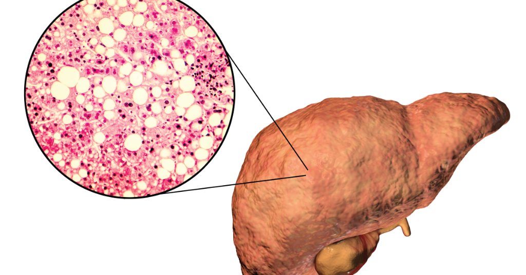 WebMD's tweet image. Fatty liver could be the most common disease you&apos;ve never heard of. At least 1 out of 4 people have it, which is more people than diabetes and arthritis combined. wb.md/2C24X4F