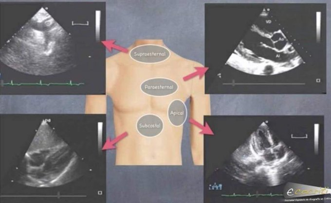 ECOGRAFÍA EN EL PACIENTE CRÍTICO. 2ª EDICIÓN 2019
Curso 100% Online Certificado con 16,2 Créditos de Formación Continuada
YA DISPONIBLE!!!
👇👇👇Sigue el Hilo para Informarte👇👇👇