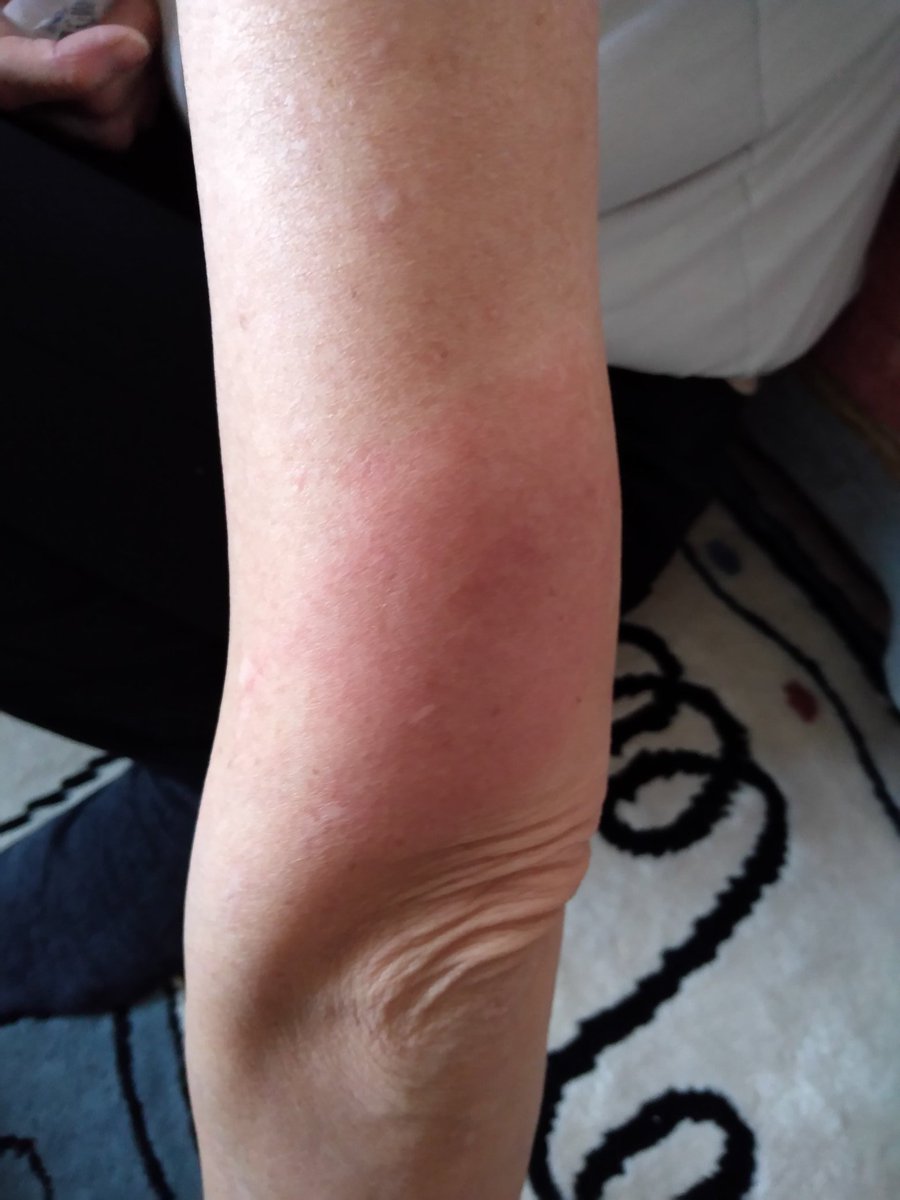 インフルエンザ ワクチン かゆい