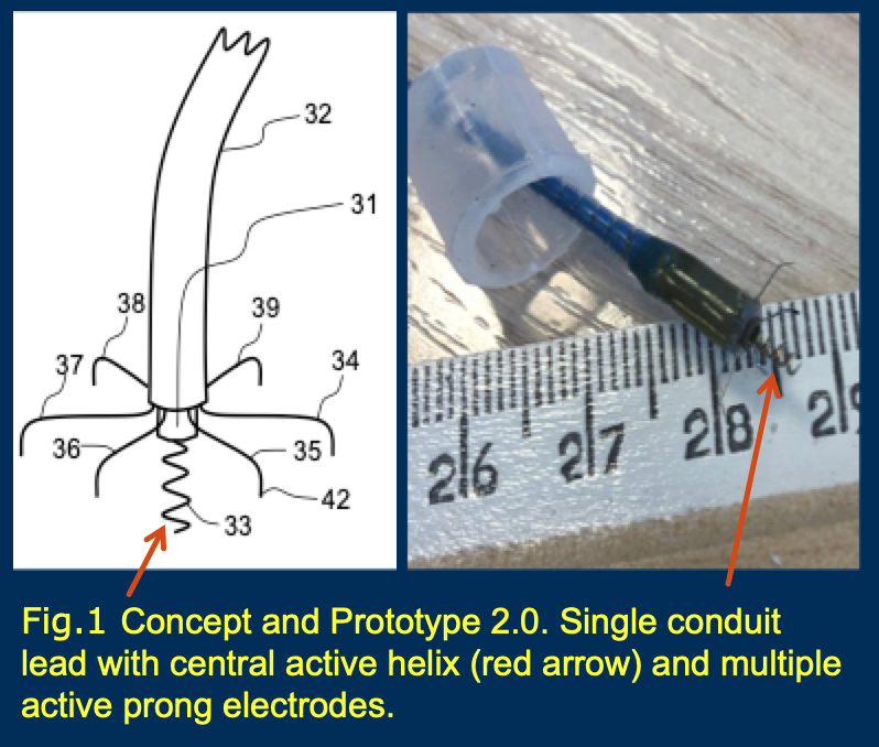 MvorlovOrlov's tweet photo. New exciting concept for pacing! Single conduit, multi pronged electrode allowing sequential pacing of atrium and His bundle from one location. Thankyou Dr Vijayaraman for participating in animal experiments.  @hisdoc1 #pps2019 #dontdisthehis  https://t.co/PTZXUomQaR https://t.co/0ujyLIRAZk