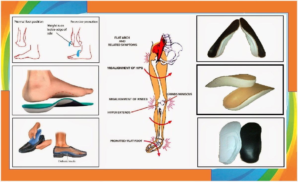Нужен ли супинатор в обуви. Ортопедические стельки для плоскостопия 3 степени. Ортопедические стельки при вальгусной деформации и плоскостопии. Ортопедические стельки при вальгусной деформации детские. Стельки супинатор 11 p.