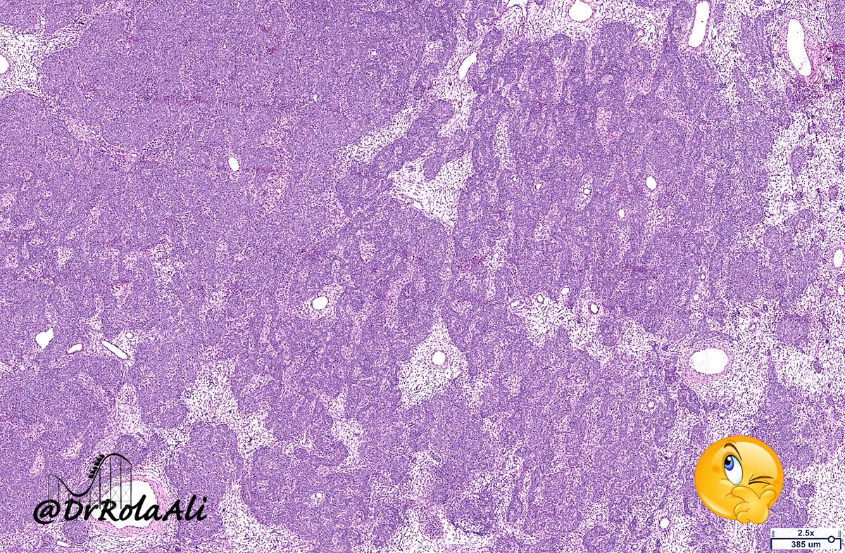DrRolaAli's tweet photo. Hey you guys!
Itβs been a while
Here is a cool caseπ’
55/F
Imaging: abdominopelvic mass 24cm
Low power views ππΌ
Will be back shortlyπ
#rolacoaster @Pathology3636 @pembeoltulu @m_isamarte @VijayPatho @DrAHLAMN1 @ADamronMD @AlanPath @Dramanyhassany1 @nusrat_xahra @HENRYY_MD https://t.co/wmKXTIcKBS
