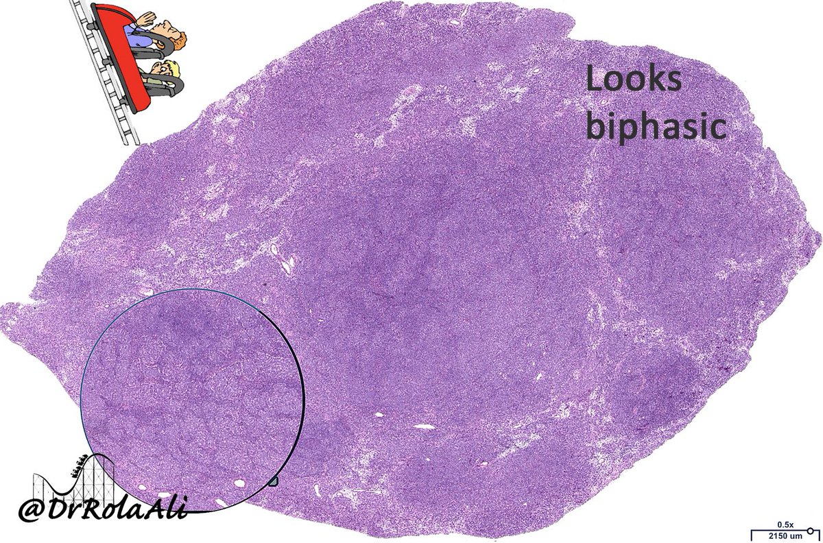 DrRolaAli's tweet photo. Hey you guys!
Itβs been a while
Here is a cool caseπ’
55/F
Imaging: abdominopelvic mass 24cm
Low power views ππΌ
Will be back shortlyπ
#rolacoaster @Pathology3636 @pembeoltulu @m_isamarte @VijayPatho @DrAHLAMN1 @ADamronMD @AlanPath @Dramanyhassany1 @nusrat_xahra @HENRYY_MD https://t.co/wmKXTIcKBS
