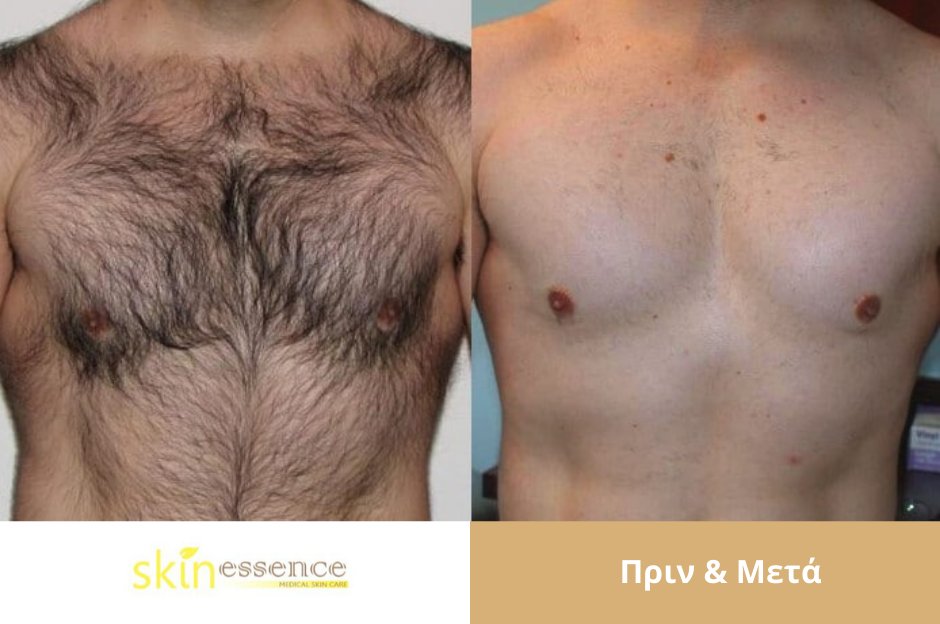 SkinEssenceGr's tweet photo. #Αποτρίχωση με Αλεξανδρίτη:εξασφαλίζει οριστική και μόνιμη απαλλαγή από την ανεπιθύμητη τριχοφυΐα με λίγες μόνο συνεδρίες. Κλείσε ραντεβού: https://t.co/3ULgA4F159…/laser-apotrichosi-swmatos/
☎ 213 0 270411
📲 698 352 8140
Γριβογιώργου 3, (δίπλα στο Hilton)

#SkinEssenceSocial https://t.co/iwOYcDQAJ7