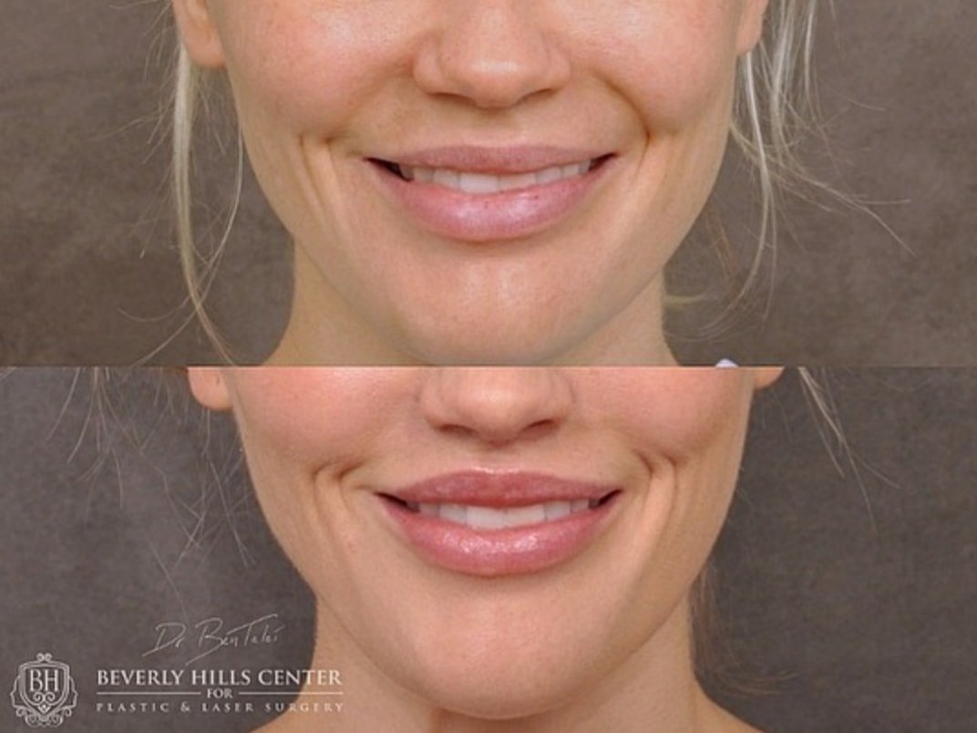 DrBenTalei's tweet photo. 𝐌𝐨𝐝𝐢𝐟𝐢𝐞𝐝 𝐔𝐩𝐩𝐞𝐫 𝐋𝐢𝐩 𝐋𝐢𝐟𝐭
Minor and subtle changes from a modified upper lip lift helped enhance this patient’s features. The lips now have more definition and accent while the teeth show much better.
https://t.co/lScMo1fo6o
#liplift #modifiedupperliplift https://t.co/evJRgKc6rG