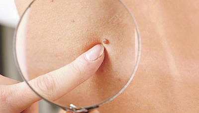 Qué son y cómo eliminar los acrocordones bit.ly/2B9ZTLL #dermatologia #laser #verrugas #cuello