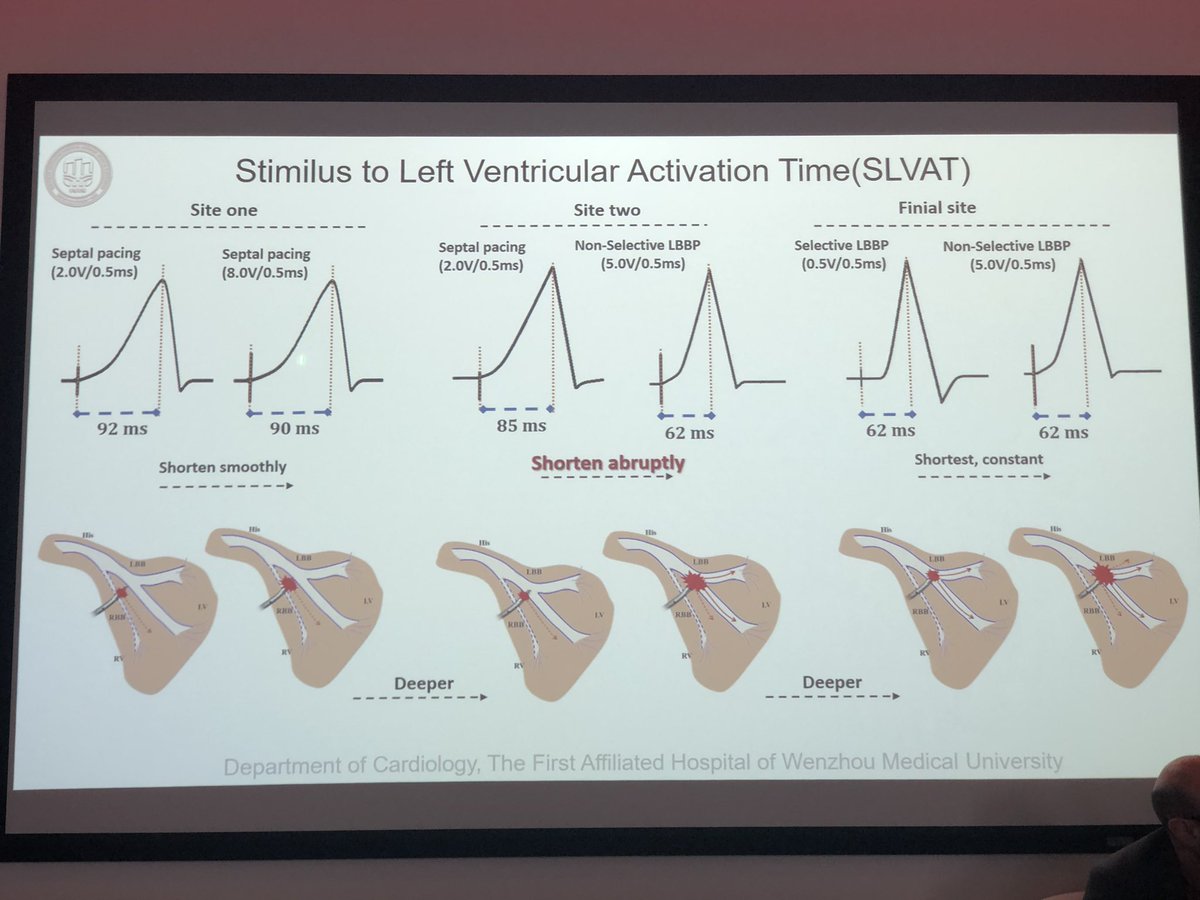 DrRoderickTung's tweet photo. Importance of LV activation time in V5 #LVAT with output dependent changes https://t.co/aUICoivGYm