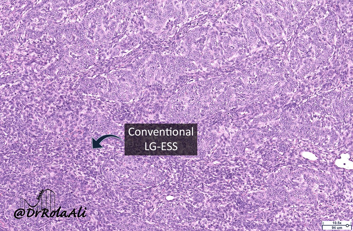 DrRolaAli's tweet photo. 5/8
Dx
π¬ Extrauterine low-grade endometrioid stromal sarcoma (LG-ESS) with smooth muscle differentiation and sex-cord differentiation
𧬠Targeted RNA sequencing (Archer): JAZF1-SUZ12 fusion due to t(7;17) -> most common translocation in LG-ESS
#rolacoaster https://t.co/pX5I34HZMo