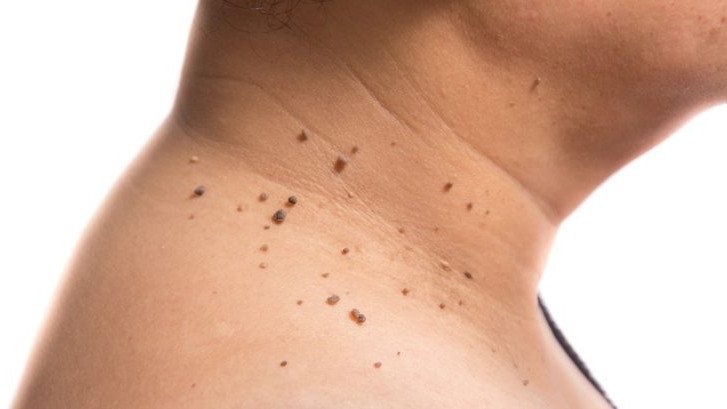 Qué son y cómo eliminar los acrocordones bit.ly/2B9ZTLL #dermatologia #laser #verrugas #cuello