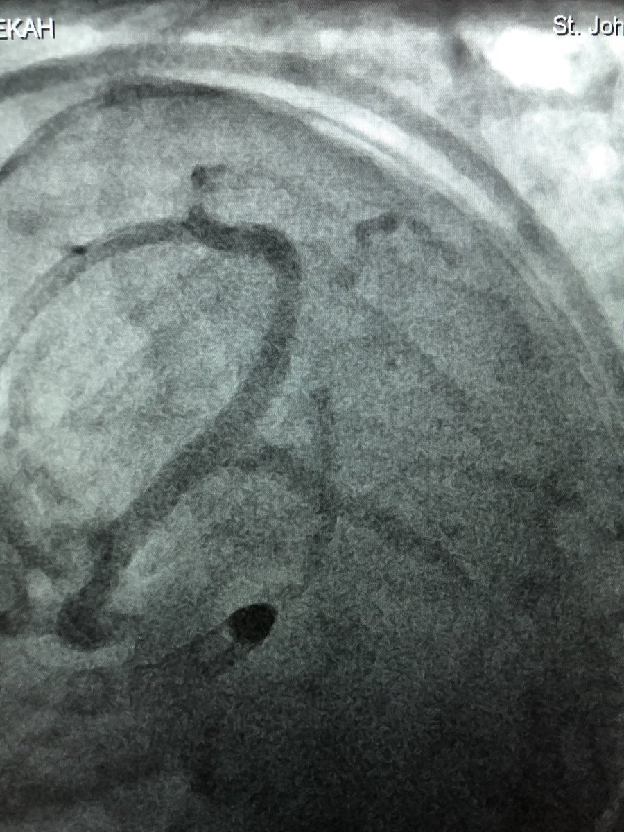 DrAmirKaki's tweet photo. 73 y/o female admitted for ACS. CT surgery turned down for porcelain aorta.  Turns out everything was porcelain, the lilacs, axillary, and coronaries.  With IVL, OA, MCS, and bifurcation stenting we were able to revascularize this complex anatomy successfully. #maverickandgoose https://t.co/Ei9wGsUEpR