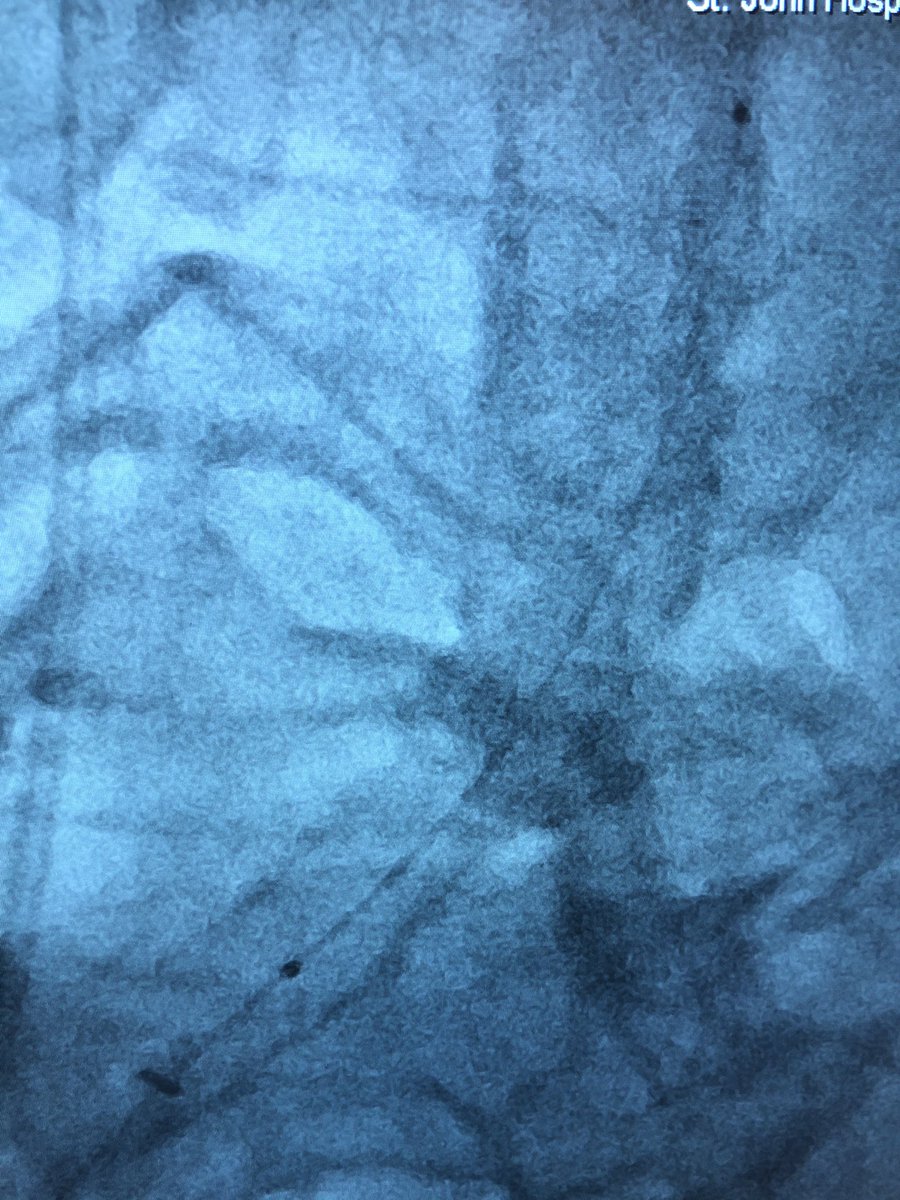 DrAmirKaki's tweet photo. 73 y/o female admitted for ACS. CT surgery turned down for porcelain aorta.  Turns out everything was porcelain, the lilacs, axillary, and coronaries.  With IVL, OA, MCS, and bifurcation stenting we were able to revascularize this complex anatomy successfully. #maverickandgoose https://t.co/Ei9wGsUEpR