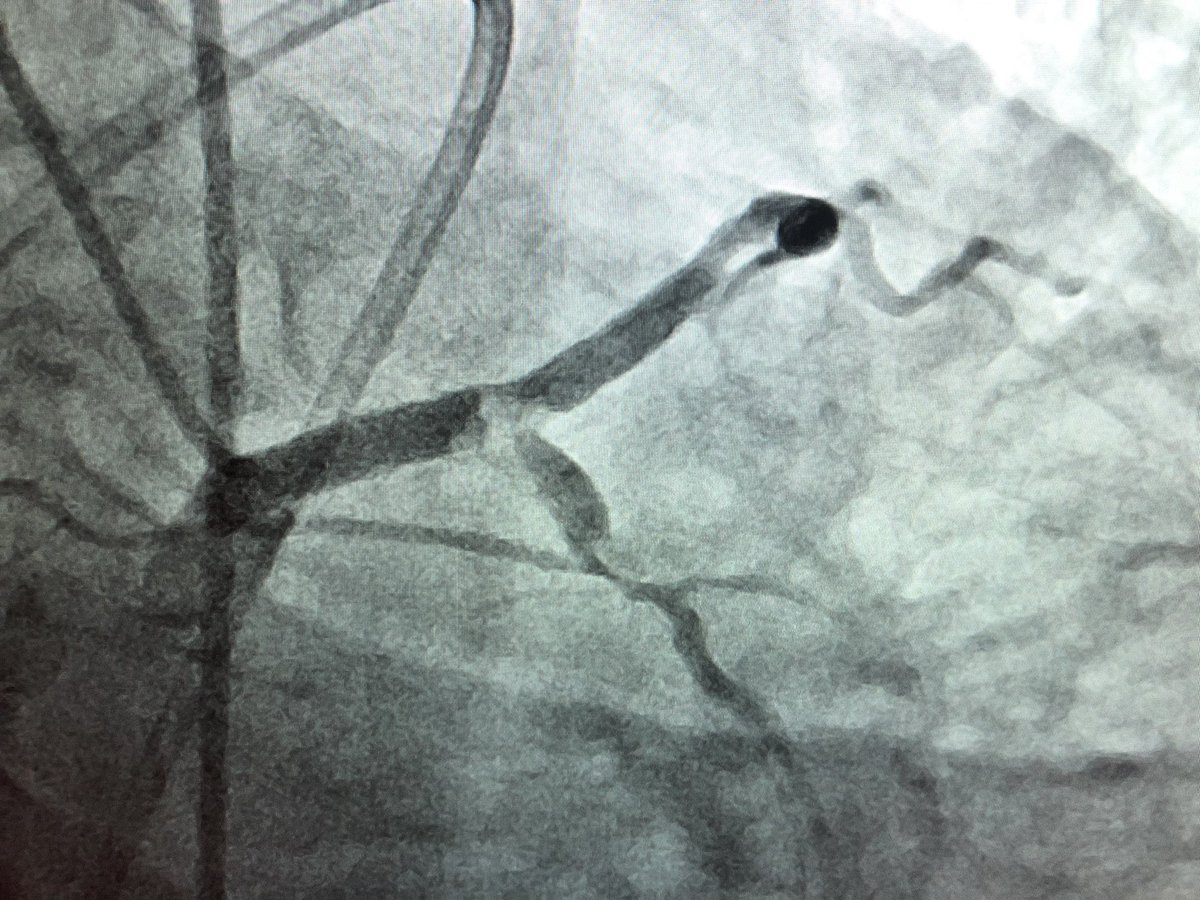 DrAmirKaki's tweet photo. 73 y/o female admitted for ACS. CT surgery turned down for porcelain aorta.  Turns out everything was porcelain, the lilacs, axillary, and coronaries.  With IVL, OA, MCS, and bifurcation stenting we were able to revascularize this complex anatomy successfully. #maverickandgoose https://t.co/Ei9wGsUEpR
