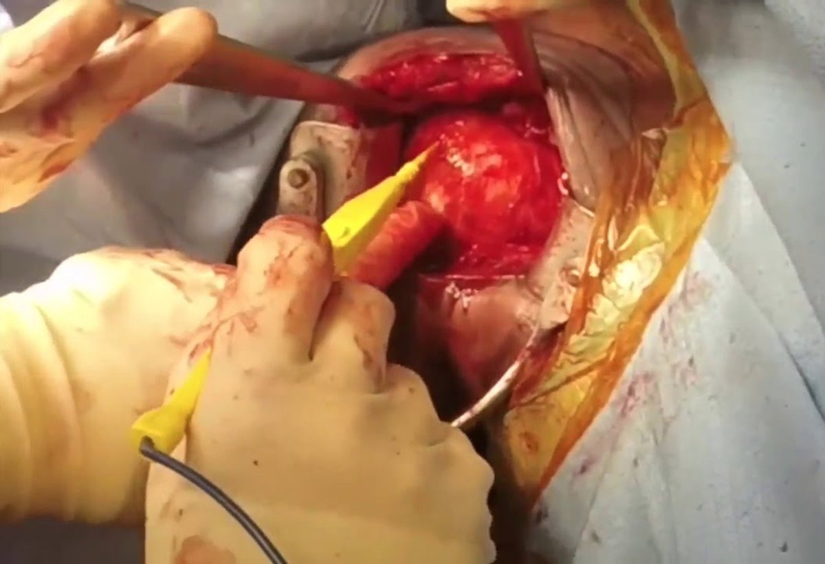 drprovencher's tweet image. What is a Latarjet procedure?

Answer: #Latarjetprocedure is typically reserved if a patient experiences anterior (to the front of the shoulder socket) bone loss during a dislocation, a dislocation that can&apos;t be reduced, or chronic shoulder instability. medilink.us/5mn0