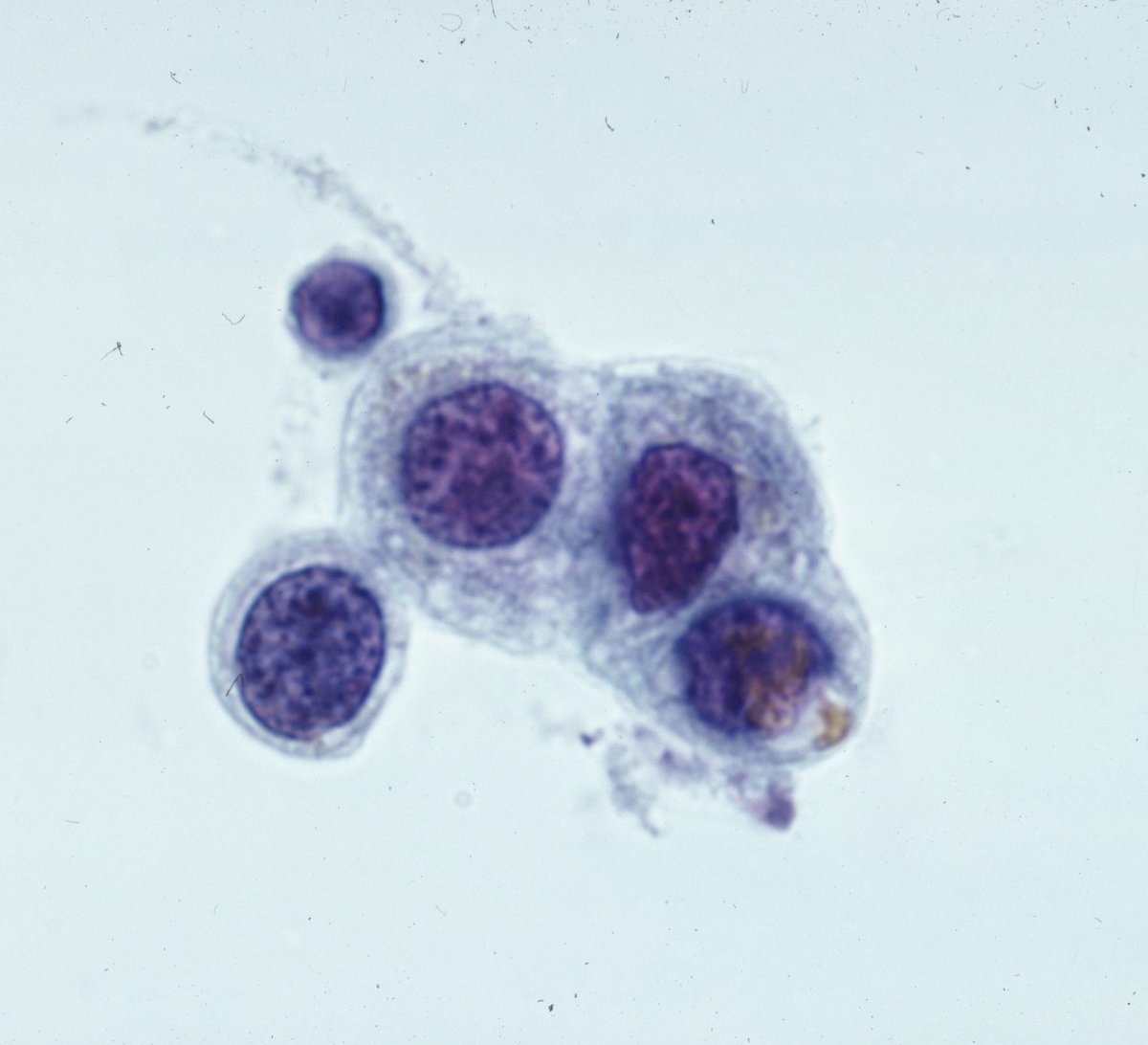 MyCytopathology's tweet photo. A urine specimen with a golden brown perinuclear pigment, consistent with lipofuscin.The differential diagnosis includes seminal vesicle cells (as in this case) and bladder lipofucinosis. The cells have enlarged focally irregular nuclei. A pitfall for the diagnosis of malignancy. https://t.co/XD3riE0tds