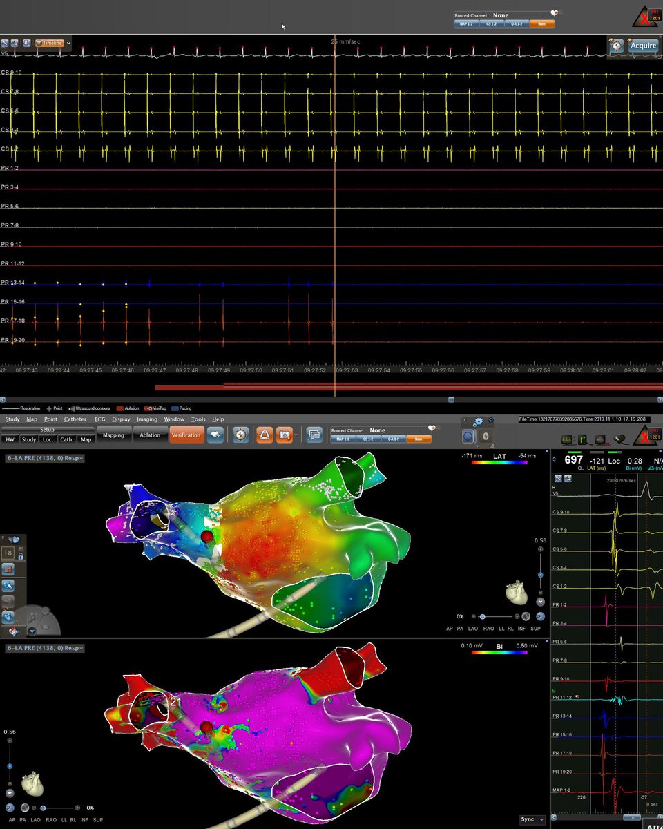 ep_travis's tweet image. #Epeeps. Redo paroxysmal AF (1st ablation not mine). Right veins reconnected. First lesion. #mapmoreburnless right ⁦@DrGregMichaud⁩. Thanks ⁦@mike_lean⁩ for a beauty.