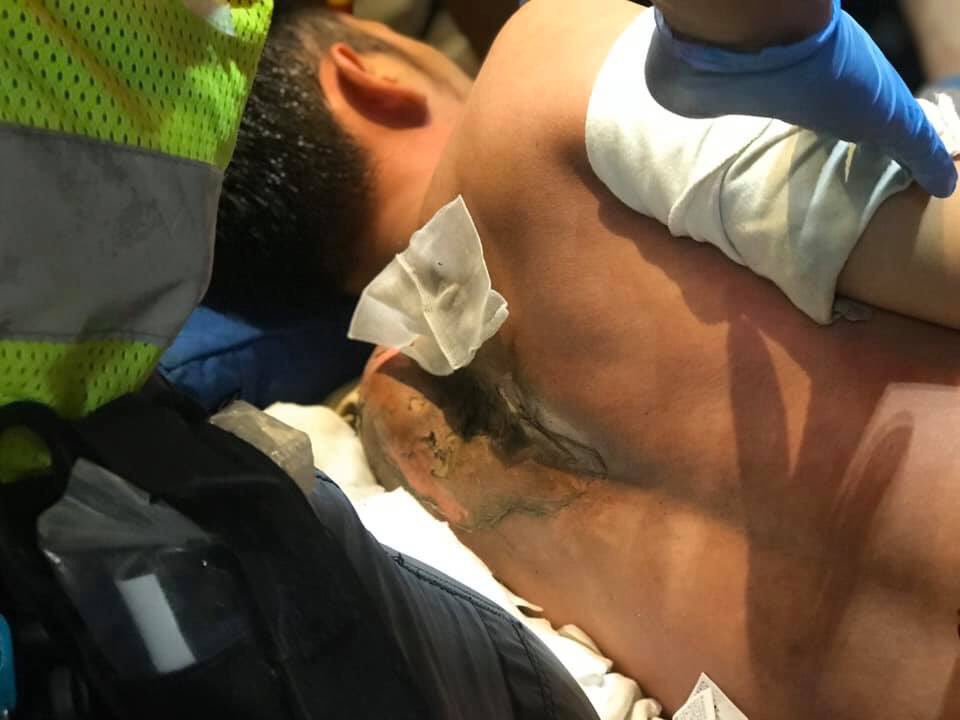 demosisto's tweet photo. A #HongKongProtester was hit by #HKPoliceTerrorists with a tear gas canister, with his skin severely burnt and his spine crushed. #PoliceBrutalityHK #PoliceState https://t.co/TNWr4VDQ1A