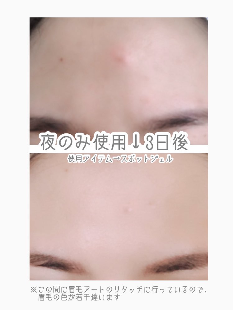 痛い 眉毛 ニキビ