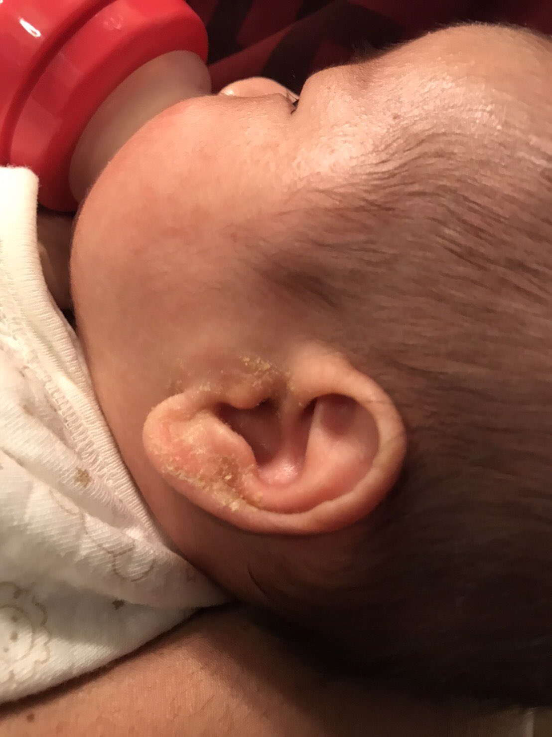 窪田 薫 耳に黄色のカサカサした塊が ニキビ潰した後出てくるアレに似てる 脂漏性皮膚炎 や 乳児湿疹 てやつ オリーブオイルでふやかして お風呂でコシコシしたら綺麗に落ちた T Co Unujzygbic Twitter