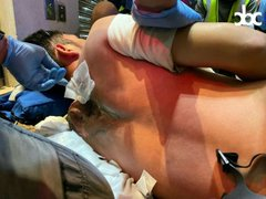 UjournalE's tweet photo. A first aiders' back was severely burnt after tear gas canisters deployed by #HongKongPolice was exploded on him.  He was in a coma and sent it to the hospital then.  
#HongKong #HongKongProtests https://t.co/NaC4FZyf6o