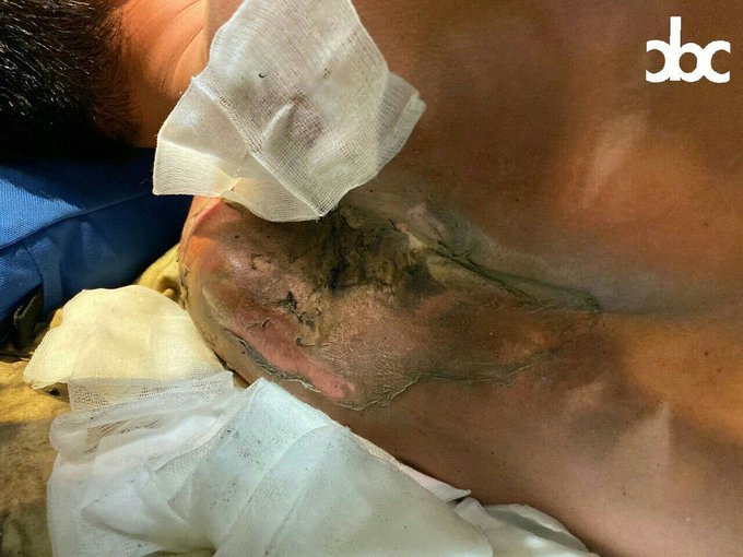 UjournalE's tweet photo. A first aiders' back was severely burnt after tear gas canisters deployed by #HongKongPolice was exploded on him.  He was in a coma and sent it to the hospital then.  
#HongKong #HongKongProtests https://t.co/NaC4FZyf6o
